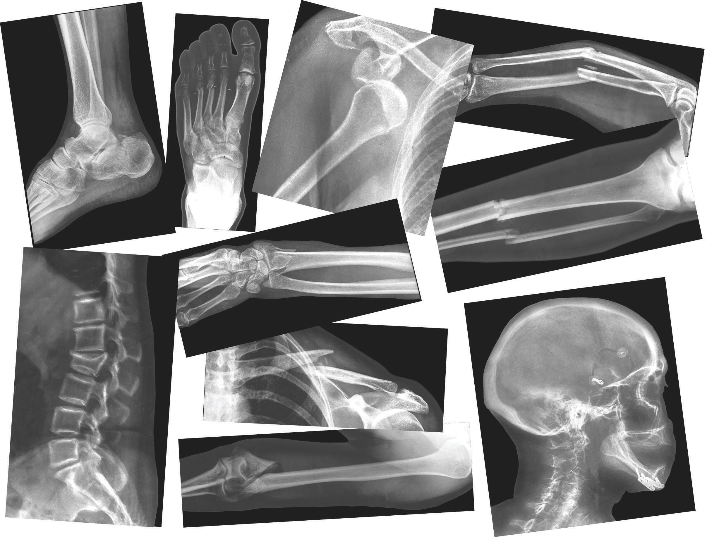 XRAYS BROKEN BONES SET OF 15