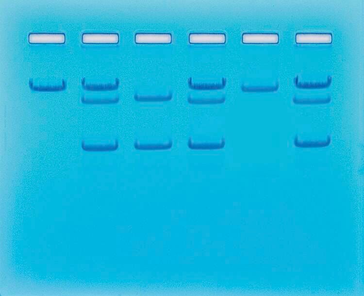 SICKLE CELL GENE DETECTION DNABASED